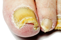 Лечение грибка ног – микоза (B35-B49)
